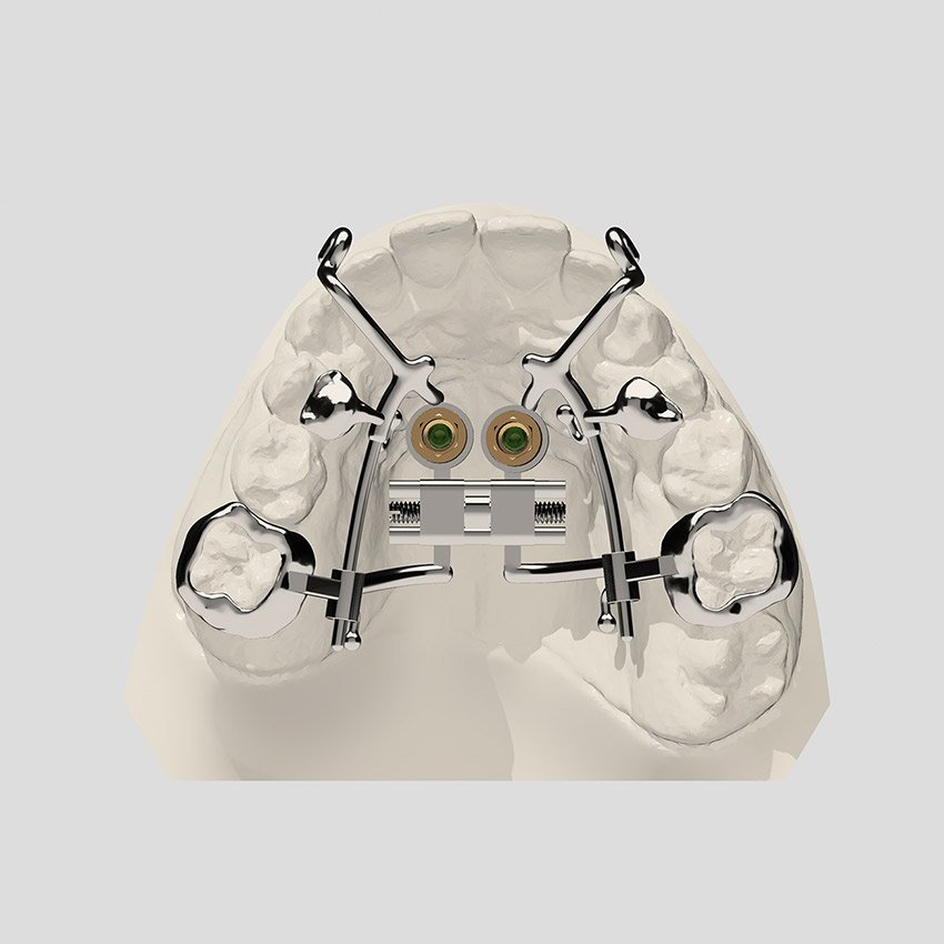 RVSX2 EBM_EXP+MESIAL+DELAIRE EBM