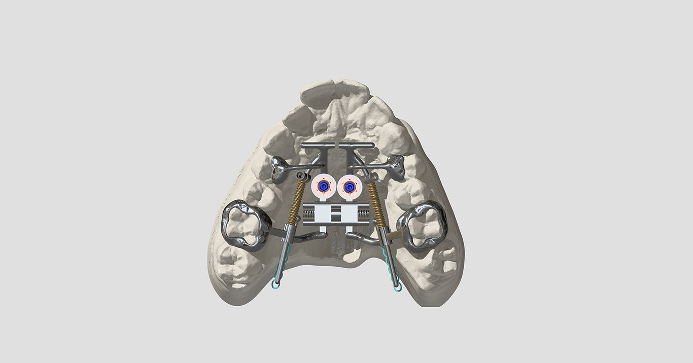 RVSX2 EBM+ DISTAL+PA